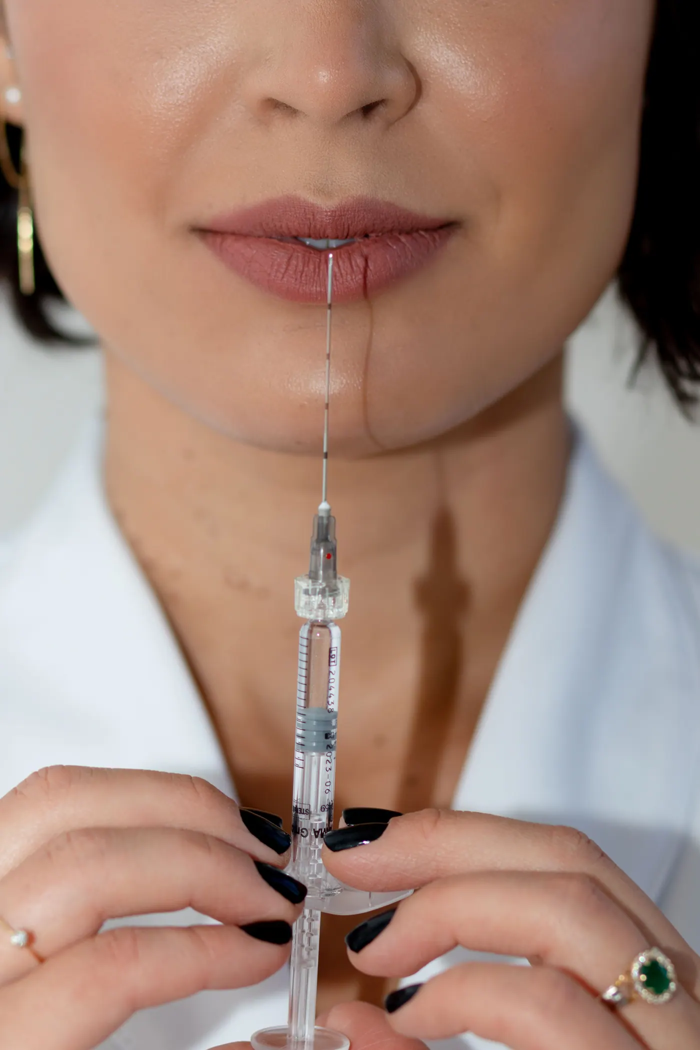Feine Unterspritzung der Lippen mit einer dünnen Kanüle in der Praxis von Dr. (univ. Te.) Nusret Fetai in Düsseldorf, Lippenbehandlung mit Hyaluronsäure