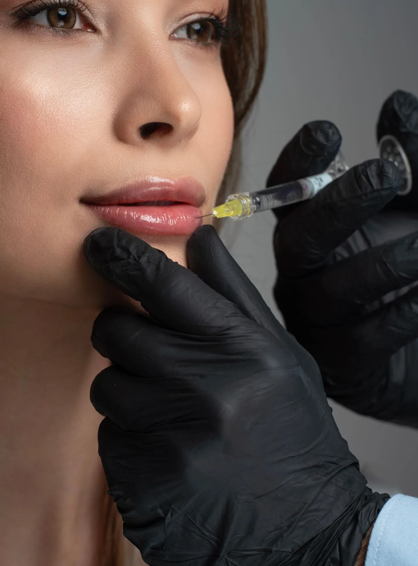 Unterspritzung der Oberlippe mit feiner Kanüle, schwarze Handschuhe, Modellaufnahme zur Hyaluronsäure Behandlung in Düsseldorf