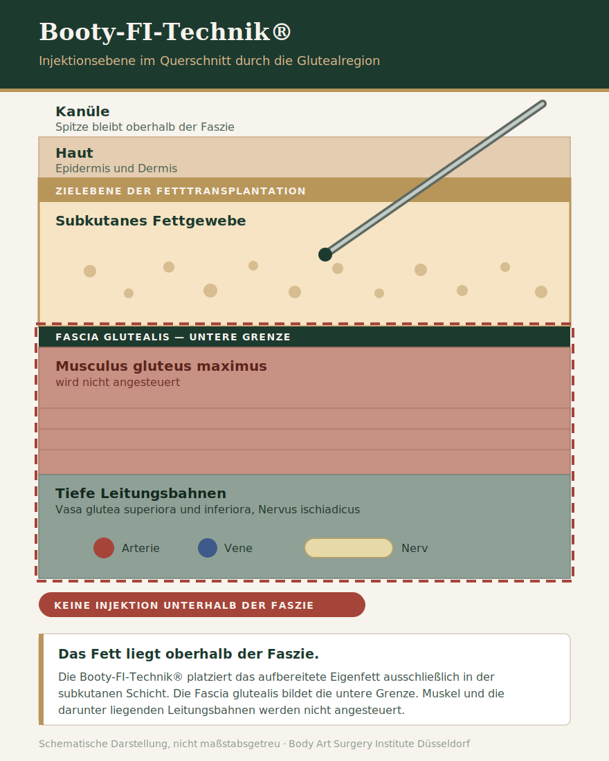 Schemazeichnung im Querschnitt durch die Glutealregion: die Kanüle der Booty·FI-Technik® endet im subkutanen Fettgewebe oberhalb der Fascia glutealis, Muskel und tiefe Leitungsbahnen liegen innerhalb der rot markierten Sperrzone