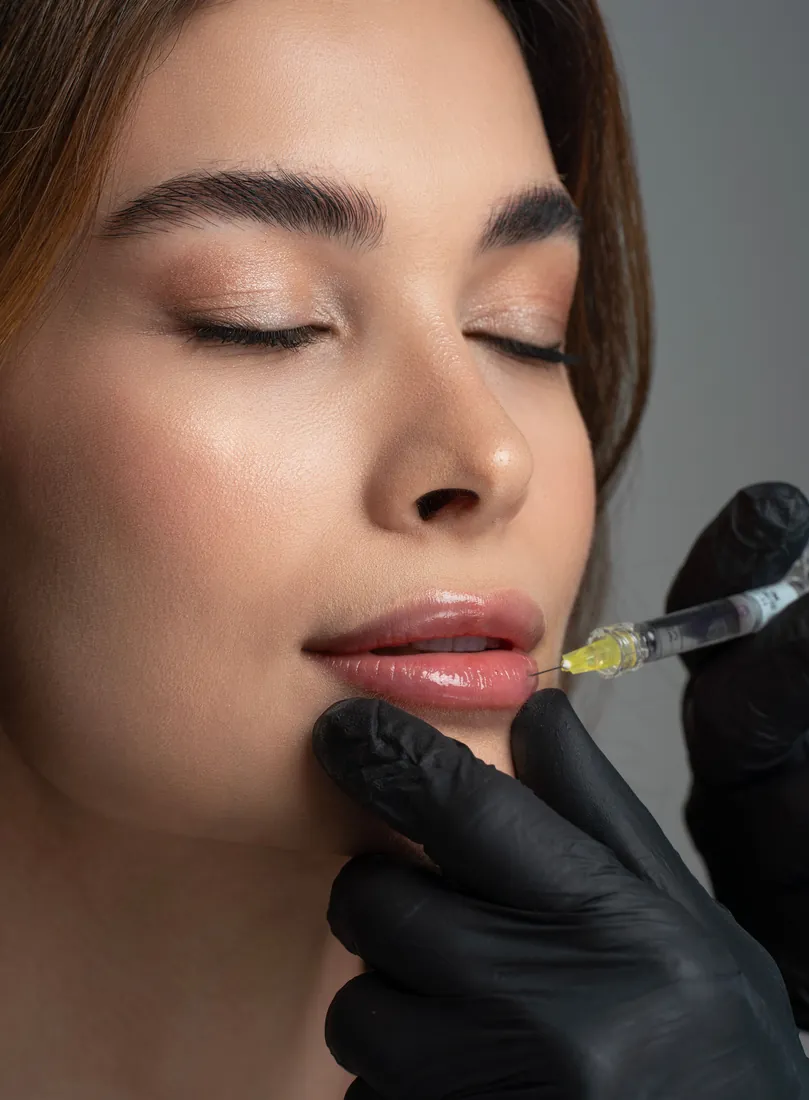 Russian Lips in Düsseldorf, Lippenfiller mit vertikaler Technik beim Arzt